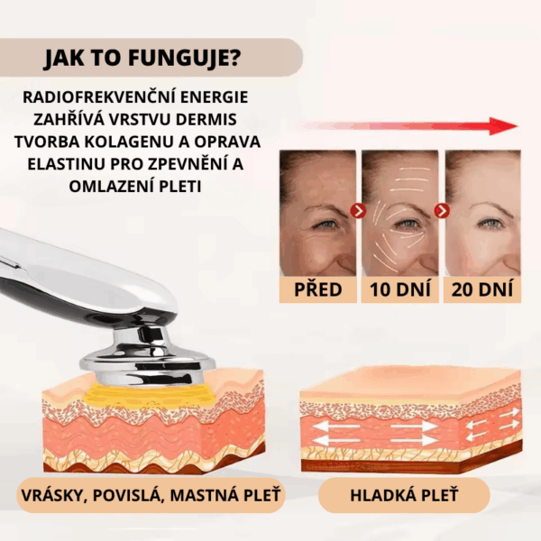 Schéma znázorňující účinek radiofrekvenční energie na omlazení pleti, včetně srovnání stavu pleti před zákrokem, po 10 a 20 dnech, s ilustrací vrstev pokožky a jejích změn.