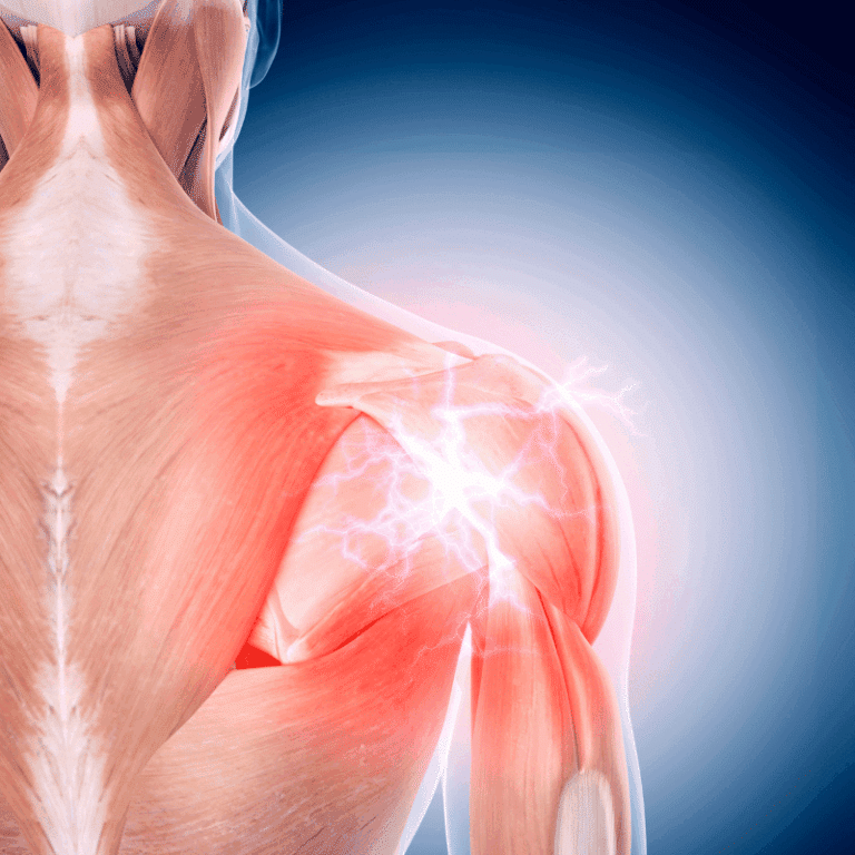 Anatomický 3D model ramenního kloubu s vyznačením bolesti červeným osvětlením, zobrazující detailní strukturu svalů a kloubního spojení z bočního pohledu.