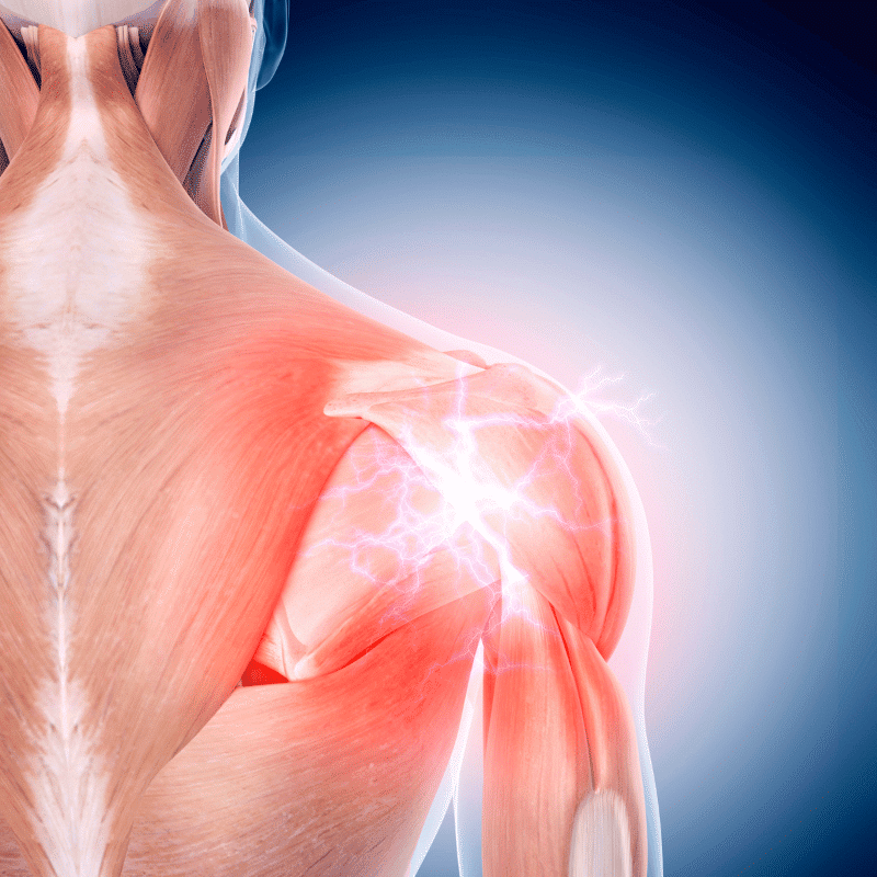 Anatomický 3D model ramenního kloubu s vyznačením bolesti červeným osvětlením, zobrazující detailní strukturu svalů a kloubního spojení z bočního pohledu.
