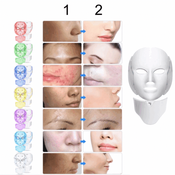 Srovnání pleti před a po ošetření s barevně vyznačenými oblastmi obličeje, ukazující zlepšení stavu pleti od začervenání a akné po čistou, hladkou pleť.